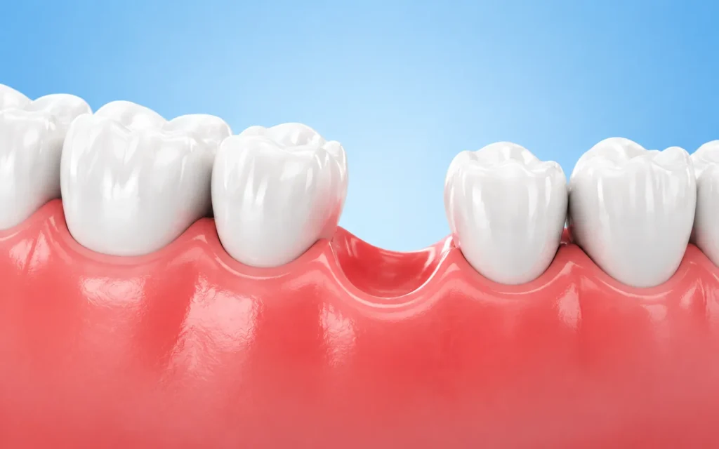 Missing a Tooth? Here Are Your Best Replacement Options — Explained Clearly