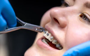 Orthodontic Procedures