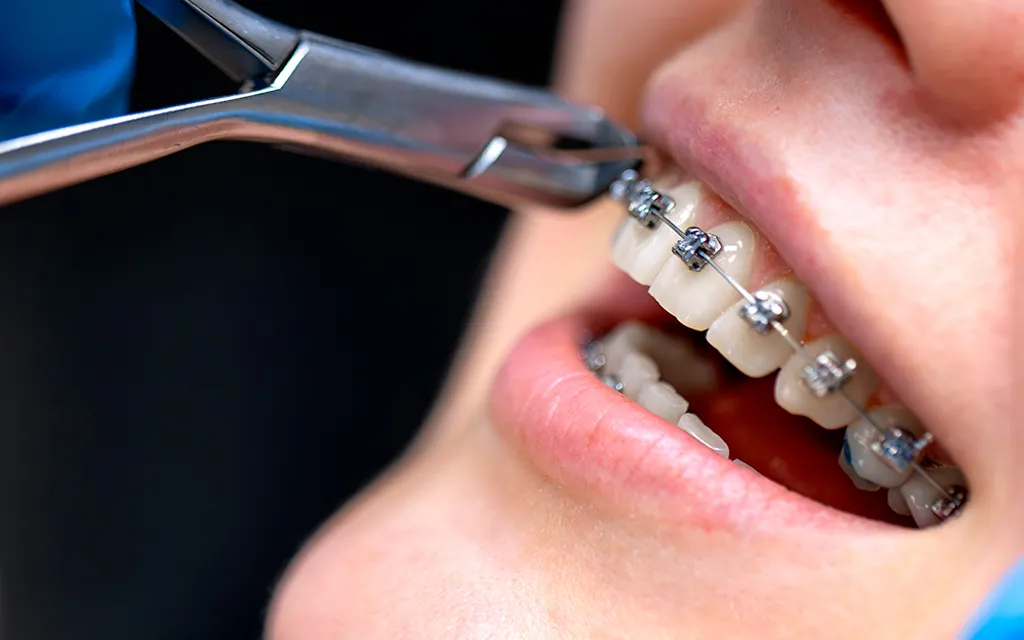 Orthodontic Procedures